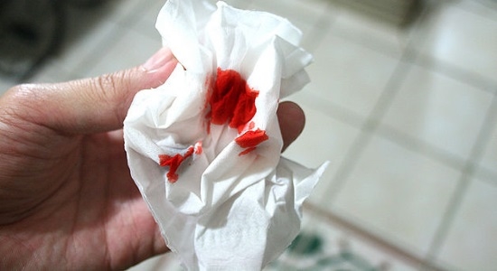 krwawiące hemoroidy